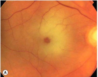Gambaran Central Retinal Vein Occlusion (CRVO) terdapat gambaran Cherry Red Spot pada makula (Salmon, 2025)