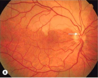 Gambaran Branch Retinal Artery Occlusion (BRAO), tampak emboli pada cabang arteri retina superior (panah) (Salmon, 2025)