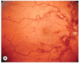 Gambaran Central Retinal Vein Occlusion (CRVO), tampak dilatasi semua pembuluh darah dan diapatkan perdarahan (flame dan dot-blot) serta edema papil (Salmon, 2025)
