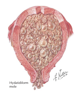 Gambar Skematis Mola Hidatidosa (Smith, 2024)