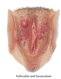 Gambaran Folikulitis dan Furunkulosis (Smith, 2024)
