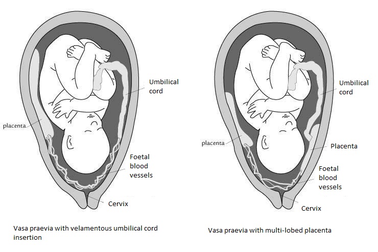 Vasa Praevia: Velamentous Insertion dan Bilobed Placenta (wikimedia.org)