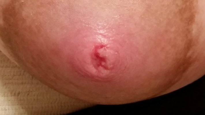 Gambar Cracked Nipple (https://www.babycenter.com)