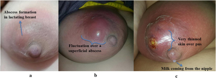 Gambaran Abses Payudara. a. Abses terbentuk pada payudara yang sedang menyusui. b. Ditemukan fluktuasi pada abses yang terletak superfisial. c. ditemukan adanya pus (https://www.sciencedirect.com)