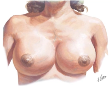 Gambaran klinis Breast engorgement (bendungan ASI) (Smith, 2024)