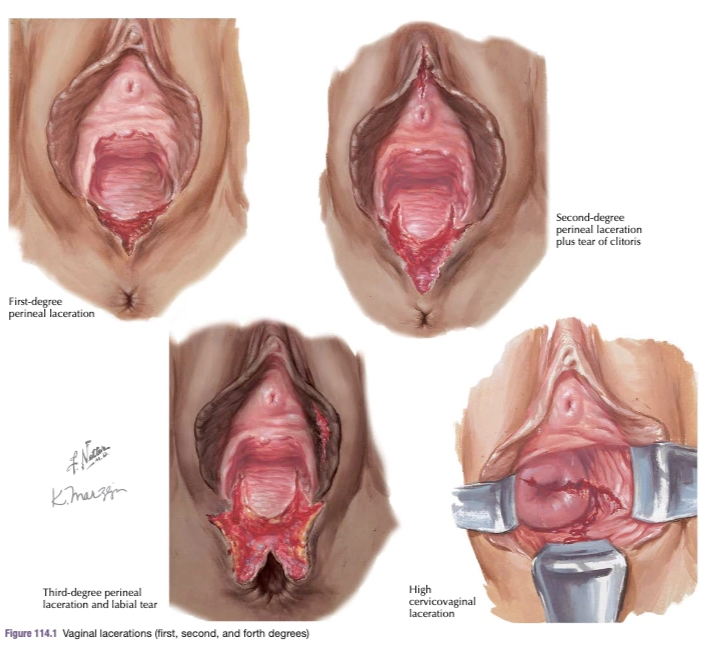Klasifikasi Laserasi Perineum (Smith, 2024)