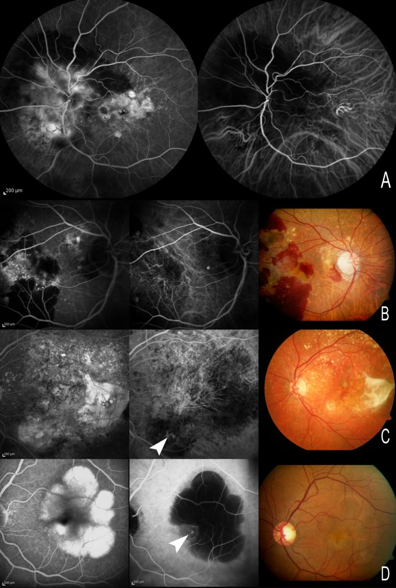 (A) Molekul ICG memiliki sifat biofisik yang menjadikannya bermanfaat untuk memvisualisasi sirkulasi koroid. (B, C, dan D) Sifat ini memungkinkan visualisasi neovaskularisasi koroid di bawah lapisan darah, eksudat, atau retinal pigment epithelium detachment (PED), dengan membedakan (pada kasus PED) antara komponen serosa yang hipofluoresen dan komponen vaskular yang hiperfluoresen. Dengan fluorescein angiografi (FA), baik komponen serosa maupun vaskular tampak hiperfluoresen, sehingga batas CNV dapat tertutup. A dan B: Visualisasi sirkulasi koroid di bawah lapisan darah tipis. C: “Hot spots” tampak pada area eksudasi. D: PED dengan CNV kecil di tepi lesi. Dengan FA, baik komponen serosa maupun vaskular tampak hiperfluoresen, sedangkan dengan ICGA hanya komponen vaskular dari PED yang tampak hiperfluoresen.(https://amdbook.org/content/diagnostic-usefulness-indocyanine-green-angiography-icga-age-related-macular-degeneration-am)