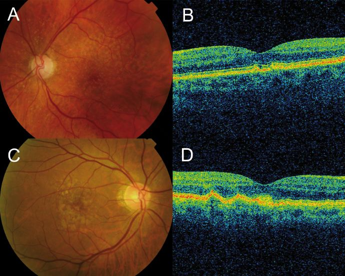 Drusen are seen as undulations and elevations in the hyperreflective band of the RPE with less reflective material beneath them, while the inner retinal layers remain generally intact. https://amdbook.org/content/optical-coherence-tomography-age-related-macular-degeneration