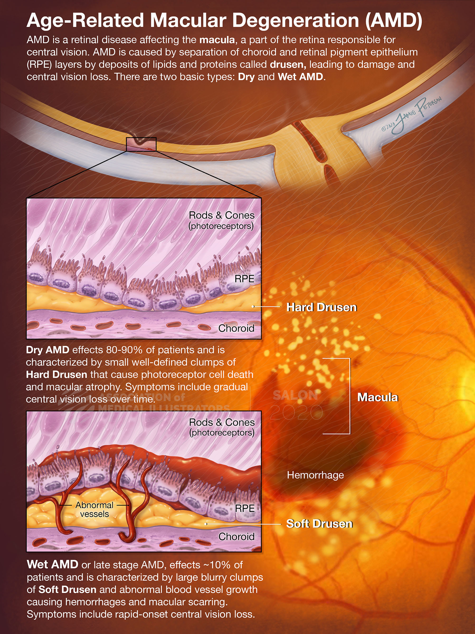 https://meetingarchive.ami.org/2020/project/age-related-macular-degen/