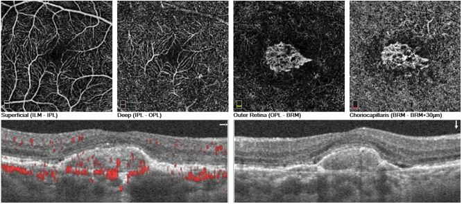 Contoh lesi CNV aktif yang diambil menggunakan sistem Optovue Angiovue OCTA. Pleksus retina superfisial dan dalam digambarkan, bersama dengan retina luar (yang secara normal avaskular) dan koriokapiler. Tampak adanya jaringan CNV padat berupa jalinan loop, anastomosis perifer, dan dikelilingi oleh halo hipo-intens. Pada pemeriksaan SD-OCT terlihat adanya cairan subretina.. (http://www.amdbook.org/node/509)