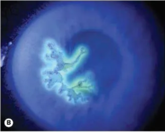 Pewarnaan fluorescein yang menunjukkan lesi berbentuk dendrit dengan terminal bulb (Salmon, 2025)