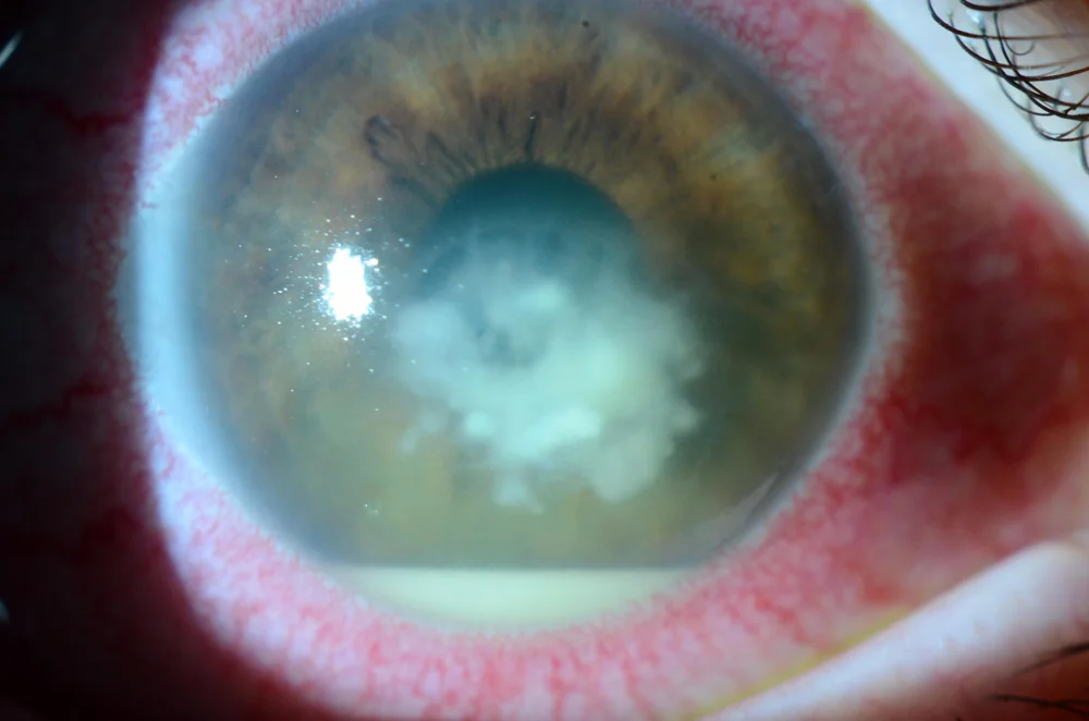 Foto slit lamp ulkus jamur Fusarium: tampak infiltrat putih multifokal non-supuratif dengan tepi feathery/filamentous, epitel di atasnya masih utuh, disertai hipopion.(https://www.eyeworld.org/)