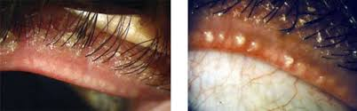 Blefaritis anterior dan posterior