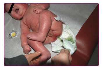 Bayi 4 bulan dengan Napkin eczema, disertai feses cair kehijauan yang abnormal, sehingga perlu rujukan untuk evaluasi alergi dan penyesuaian diet.(Kang, 2019)