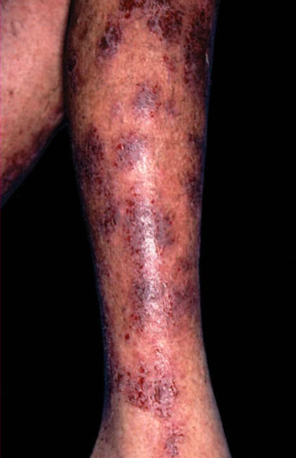Gambaran klinis dermatitis numularis (Kang dkk, 2019)