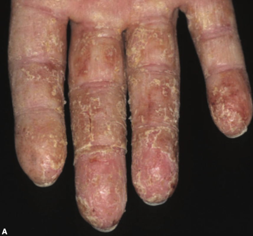 Gambaran Dermatitis Kontak Iritan Kronis dengan Eksaserbasi akut (Saavedra dkk, 2023)