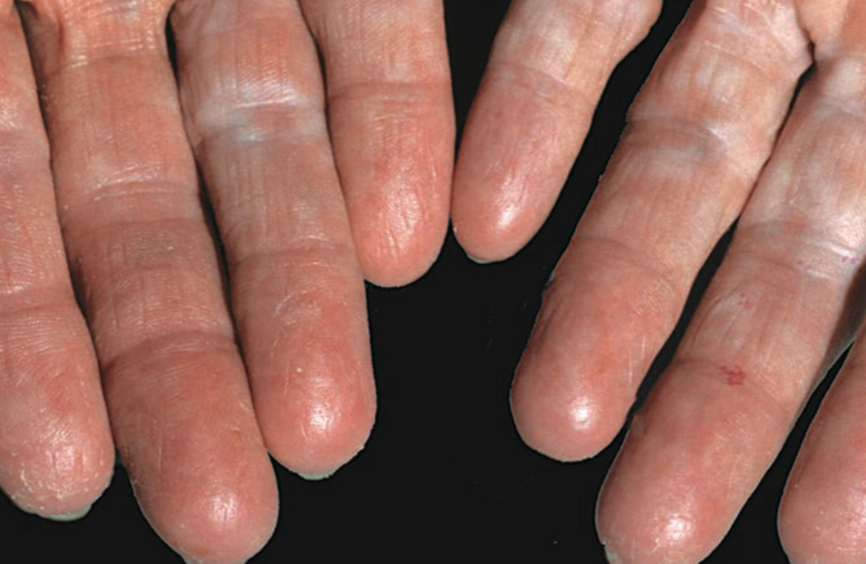Gambaran Klinis Tahap Awal Dermatitis Kontak Iritan (Saavedra dkk, 2023)