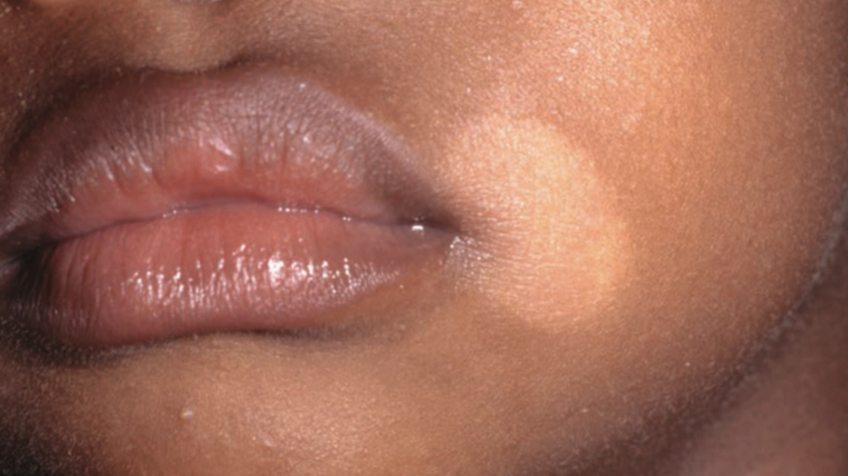 Pityriasis alba pada anak (Saavedra dkk, 2023)..