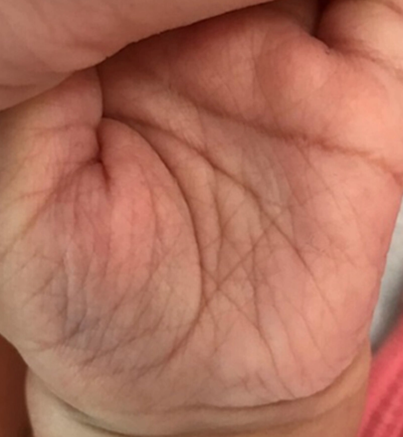 Hiperlinearitas palmar (Ruge dkk, 2022)