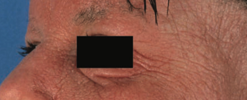 Lipatan infraorbital (Dennie-morgan fold) (Saavedra dkk, 2019)