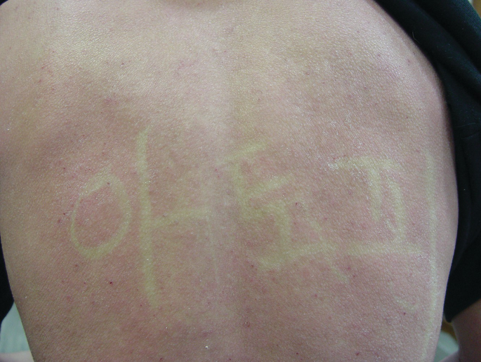 White dermatographism (Jeong, 2024)