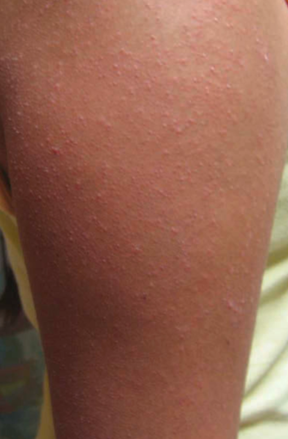 Keratosis pilaris (Kang dkk, 2019)