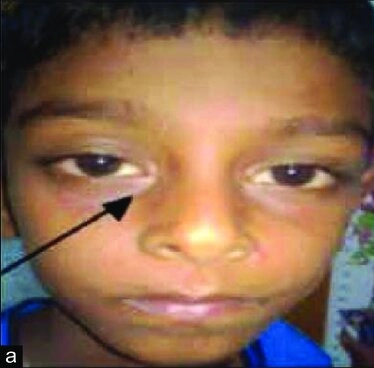 Allergic shiner (Kumar dkk, 2023)