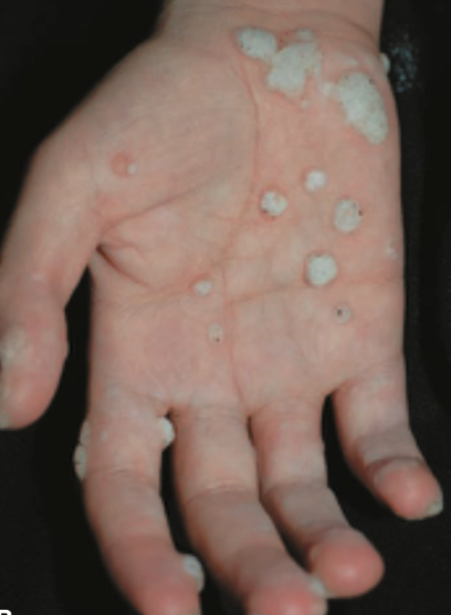 Veruka palmaris (Saavedra dkk, 2023)