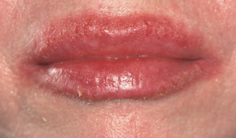 Gambaran klinis dermatitis kontak alergi akibat lipstick (Saavedra dkk, 2023)