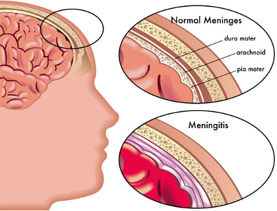 (https://meningitis-com-au)
