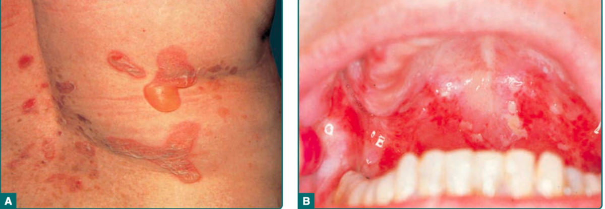 Pemphigus vulgaris A. Bullae kendur B. Erosi mukosa cavum oris (Kang dkk, 2019)