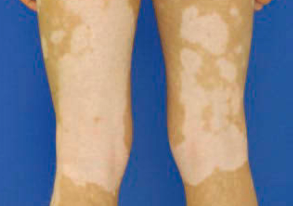 Vitiligo non-segmental (Saavedra dkk, 2023)