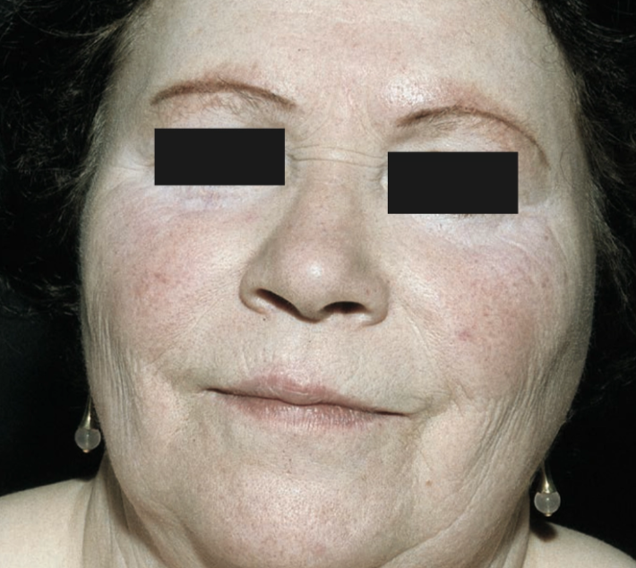 Vitiligo universal (Saavedra dkk, 2023)