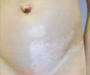 Vitiligo segmental (Saavedra dkk, 2023)