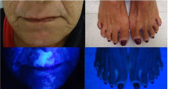 Gambaran woods lamp lesi vitiligo (Veasley dkk, 2018)