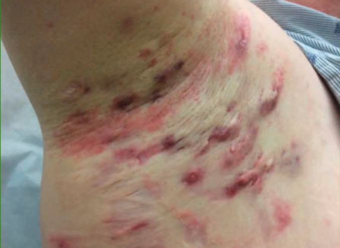 Hidradenitis supuratif pada aksila dengan nodul multipel (Kang dkk, 2019)