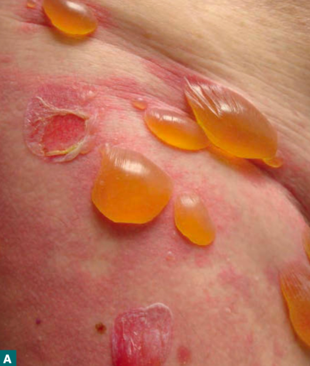 Pemphigoid bulosa dengan bullae yang tegang (Kang dkk, 2019)