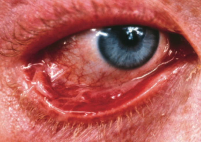 Mucous membrane pemphigoid dengan erosi pada konjungtiva (Saavedra dkk, 2023)