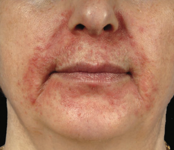 Perioral dermatitis pada area sekitar mulut dan lipatan nasolabial (Kang dkk, 2019)