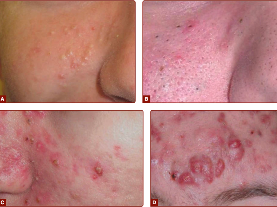A. Closed comedone, B. Open comedone, C. Papul inflamasi, D. Nodul (Kang dkk, 2019)