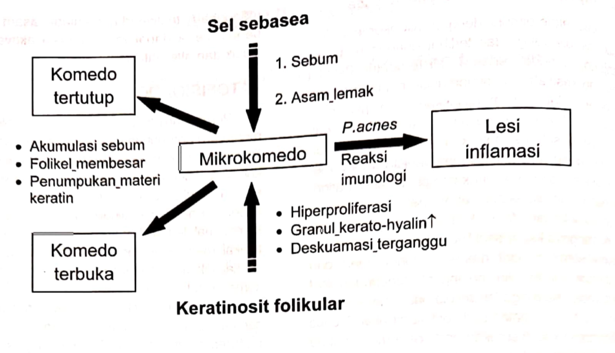 Patogenesis akne vulgaris (Djuanda dkk, 2019)
