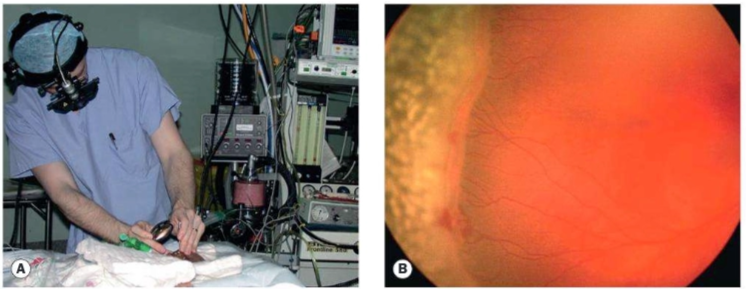 Terapi retinopeksi pada ROP. A. Laser dengan anestesi umum. B. Penampakan setelah dilakukan laser (Salmon, 2025)