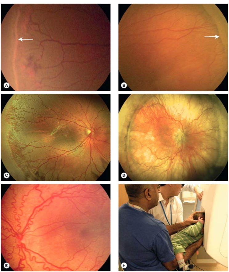 Stadium ROP. A : Stadium 1 (garis demarkasi), B. Stadium 2 tonjolan (ridge) C. Stadium 3 ridge dengan proliferasi fibrovaskular ekstraretina D. Stadium 4A ablasio retina parsial. E. Plus disease. F. Salah satu metode pemeriksaan imaging. (Salmon 2025)
