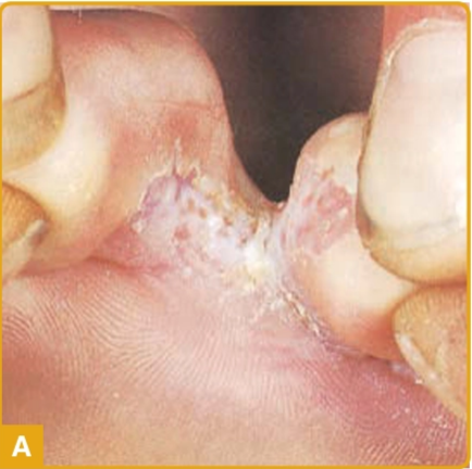 Tinea pedis tipe interdigital, tampak maserasi dengan skuama putih dan erosi (Kang dkk, 2019)