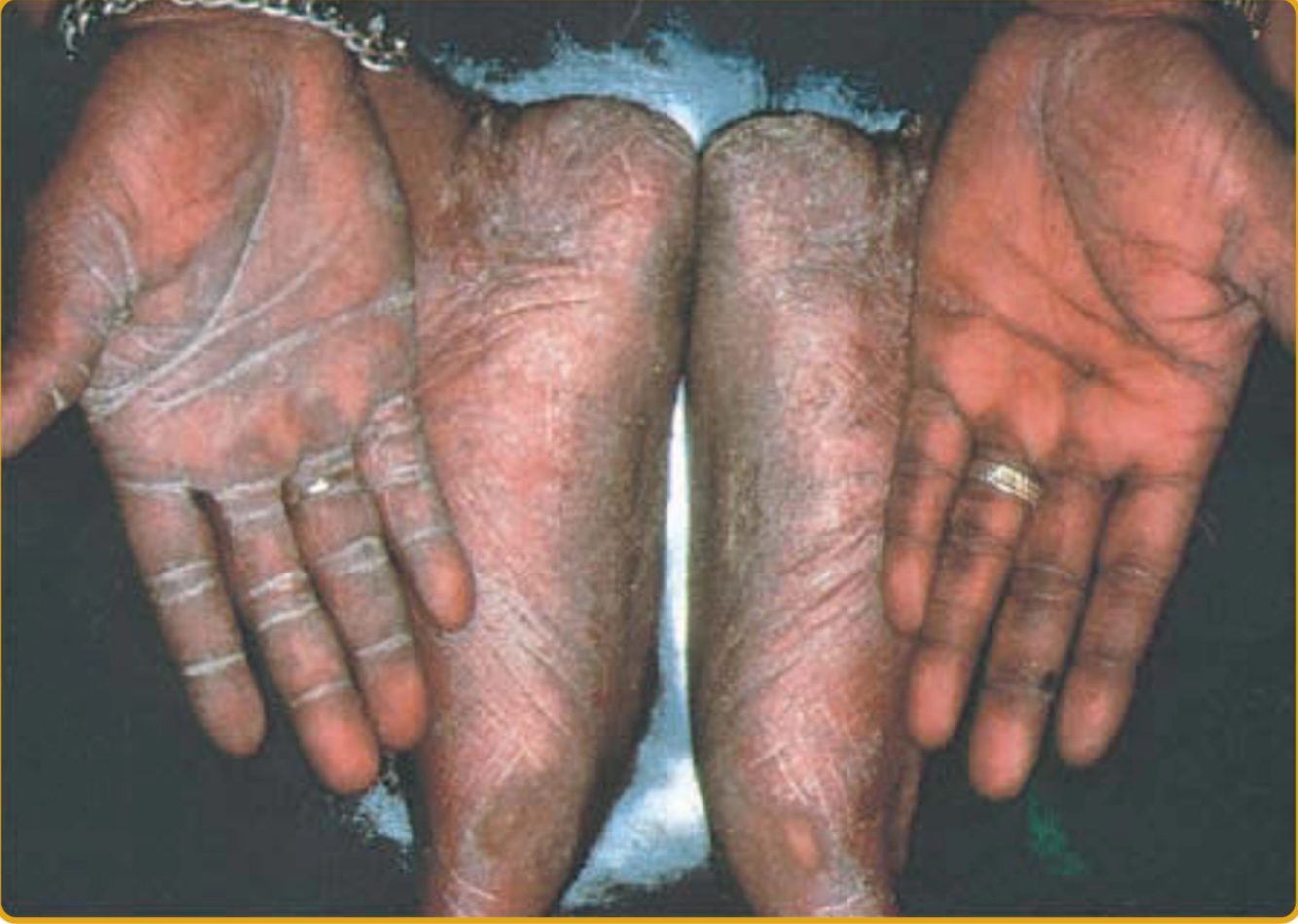 Tinea pedis dan manus membentuk gambaran two feet-one hand (Kang dkk, 2019)