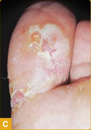Tinea pedis tipe vesikobullosa, tampak erosi akibat bullae yang ruptur dan eritema (Kang dkk, 2019)