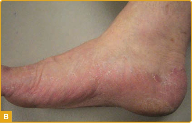 Tinea pedis tipe moccasin/hiperkeratotik, tampak eritema dan skuama pada area kaki yang tebal (Kang dkk, 2019)