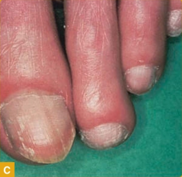 Tipe superficial white onychomycosis