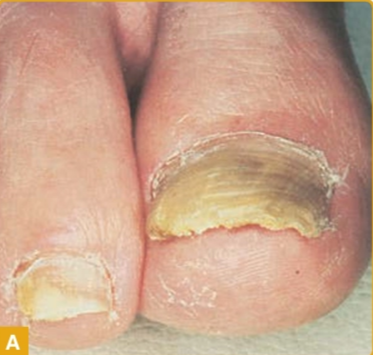 Tipe distal lateral subungual (Kang dkk, 2019)