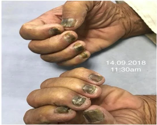 Total dystrophic onychomycosis (Saxena dkk, 2020)